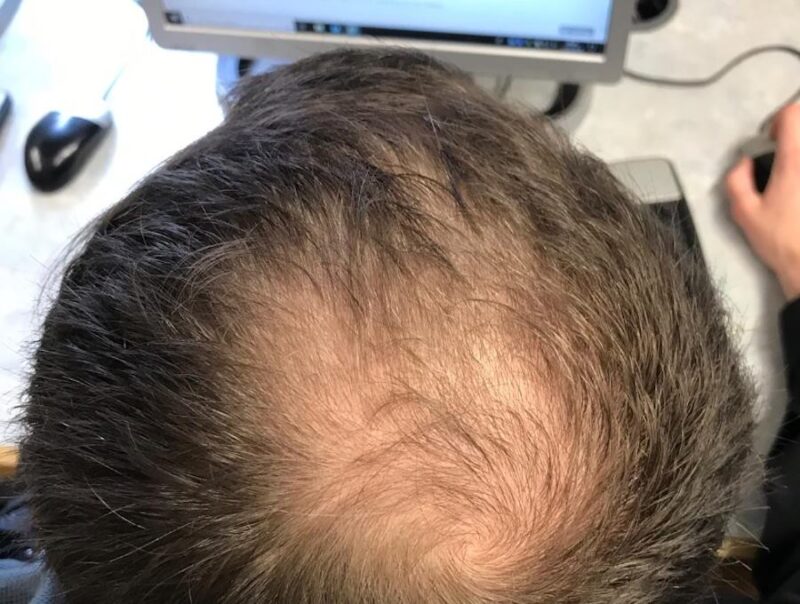 Naukowcy zidentyfikowali białko, które wspomaga odrost włosów