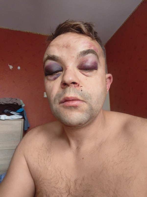 Brutalne pobicie w Gdyni na tle rasowym. Napastnik zaatakował też miejskiego radnego. „Jesteś Polakiem?”